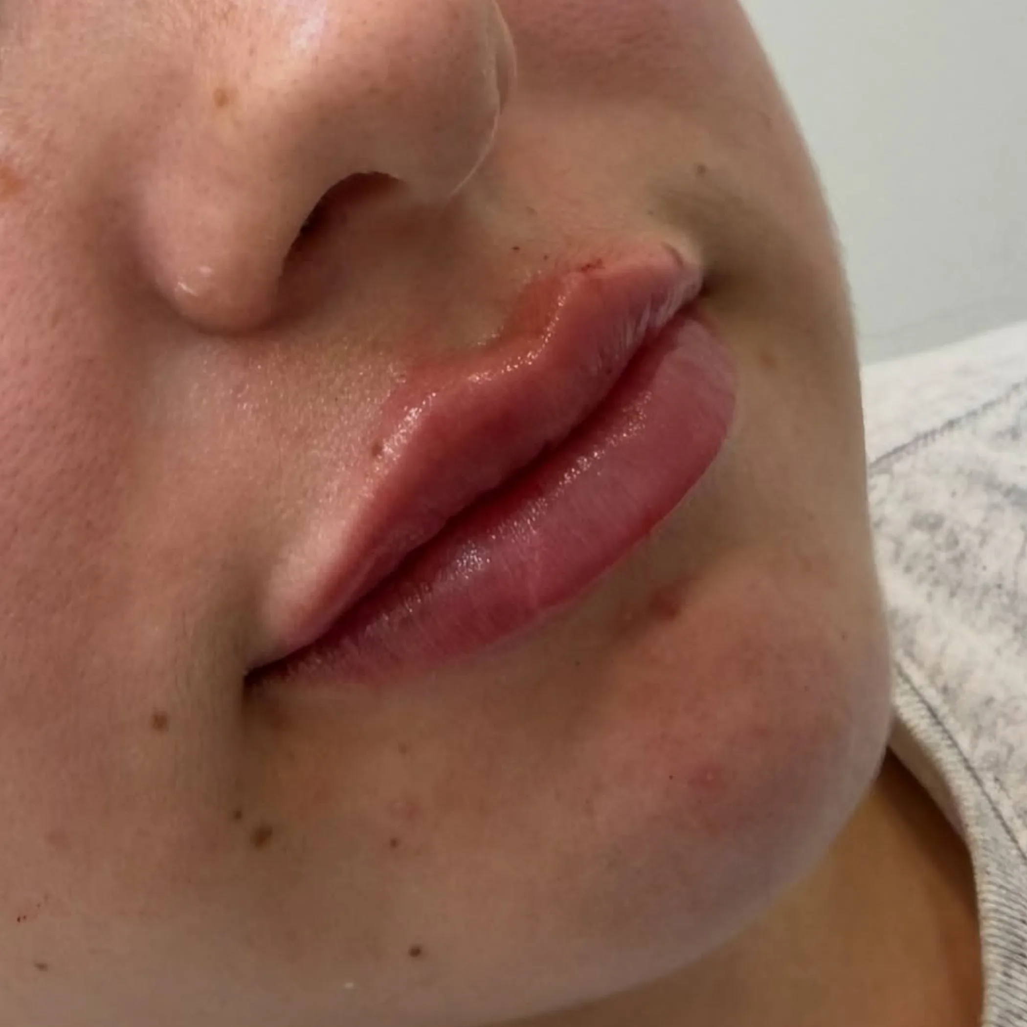 cosmetic injectable procedure